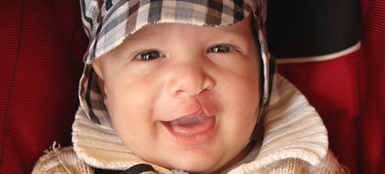 Cleft-Lip-and-Palate_opt