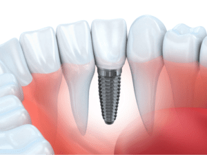 Dental-Implants-Nashville-768x577
