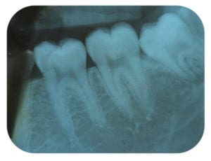 X-Ray Negative Tooth Molars