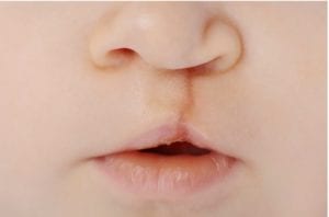 Cleft-Lip-and-Palate-TN-768x506